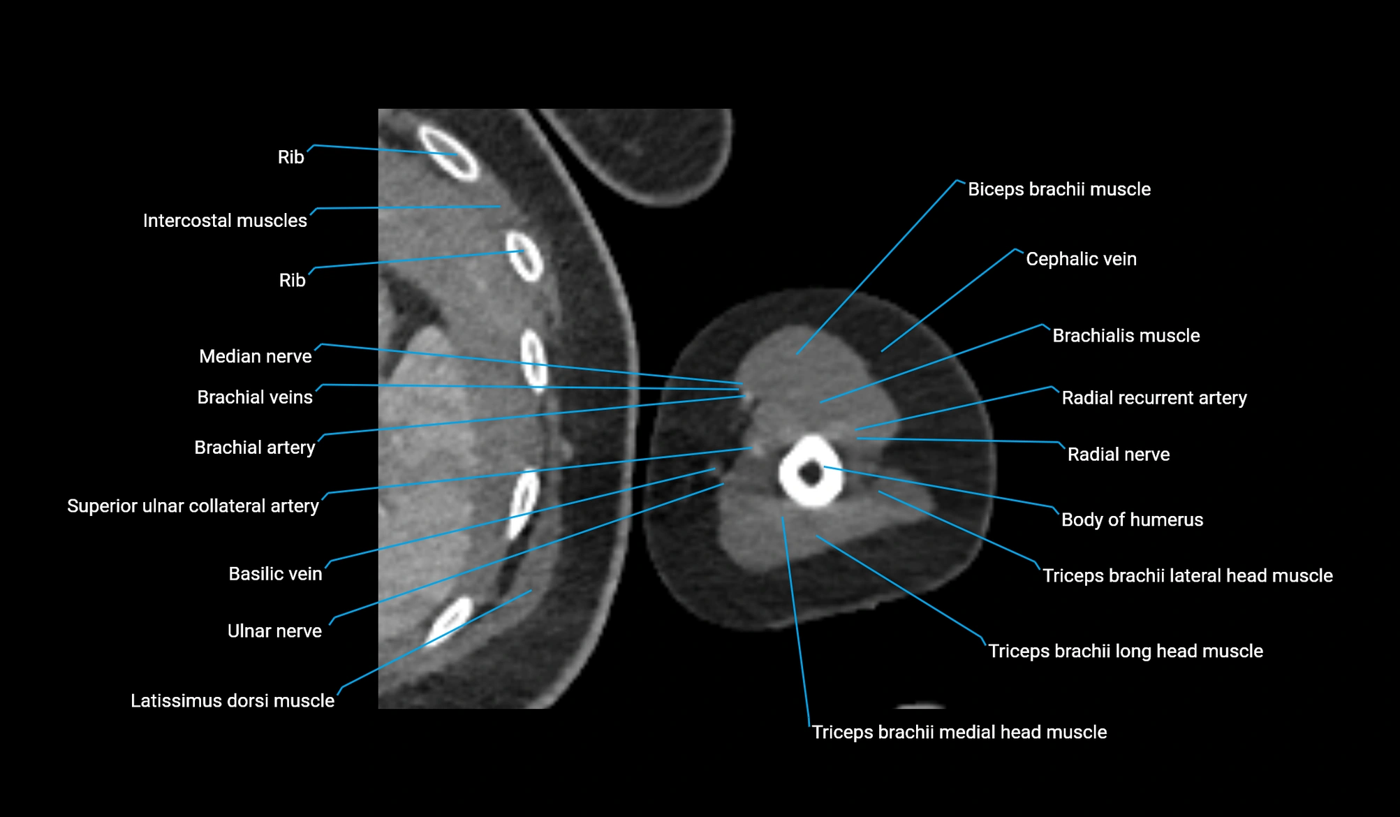 CT upper arm axial  cross sectional anatomy labelled radiology image -00294.webp
